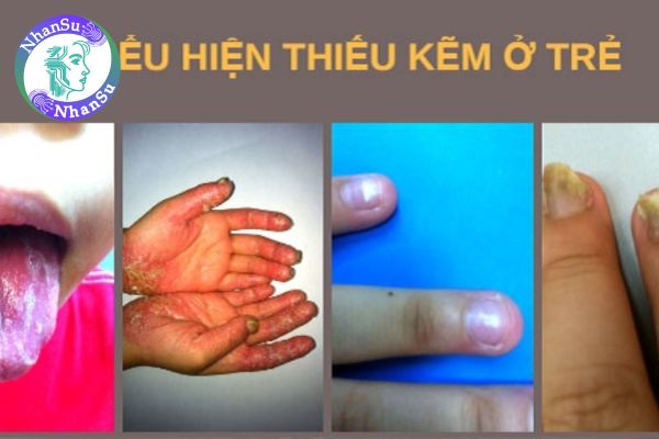 Thiếu chất kẽm dễ mắc phải bệnh lý về dinh dưỡng nào?